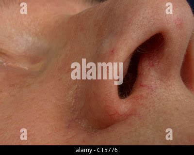 BENIGN SKIN TUMOR Stock Photo - Alamy