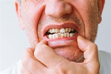 Tartar Buildup on Teeth: Warning Signs You Shouldn't Ignore