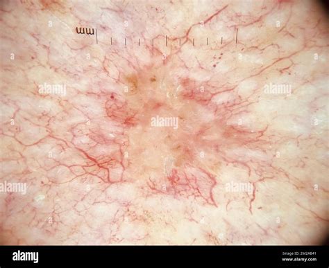 basal cell carcinoma dermoscopy stock photo alamy