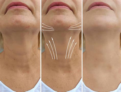 Sagging Neck: Best treatment to treat it | Dr. Anthony Bared | Miami