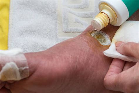 Best Diabetic Wound Care Products – Cincinnati Foot & Ankle Care