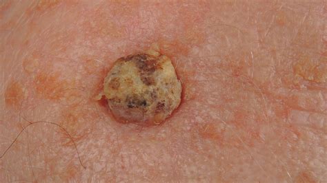 How Is Cutaneous Squamous Cell Carcinoma Treated? | Everyday Health