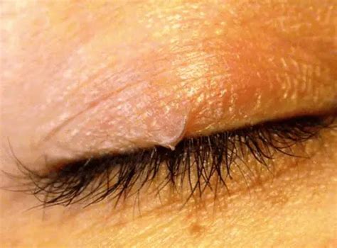 25 Inspirational Lash Mites Symptoms - Demodectic Mange