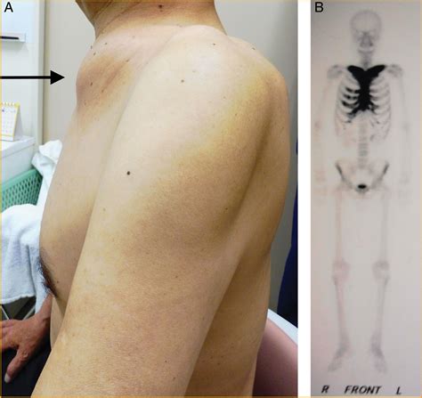 SAPHO Syndrome - The American Journal of the Medical Sciences