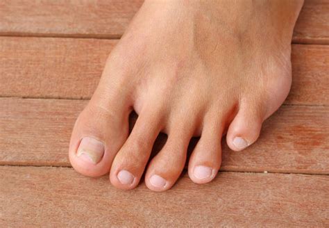 Curved Toenails Stock Photos, Pictures & Royalty-Free Images - iStock