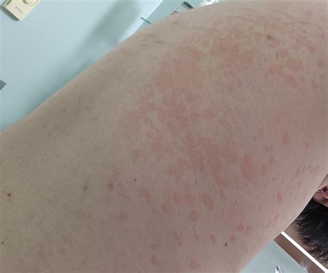 What is this? Itchy red marks. I've had them for a few years and they