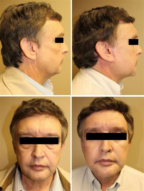 Rhytidectomy 20 | Roanoke Plastic Surgery | Norman Harris, MD