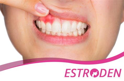 Natural Home Remedies for Gum Boil Relief | Estroden