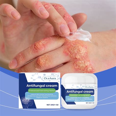 Antifungal Cream for Jock Itch: Anti Fungal Cream for Itchy Skin Relief