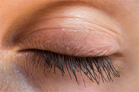 swollen eyelid   treatment