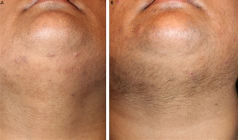 Hypertrichosis Treatment Before And After