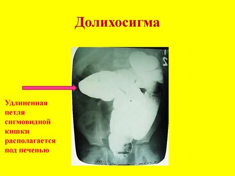 Мегаколон и доликолон у детей. Болезнь Гиршпрунга у детей - презентация ...