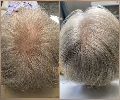 PRP-behandling tilbud - Cliniquerevoire
