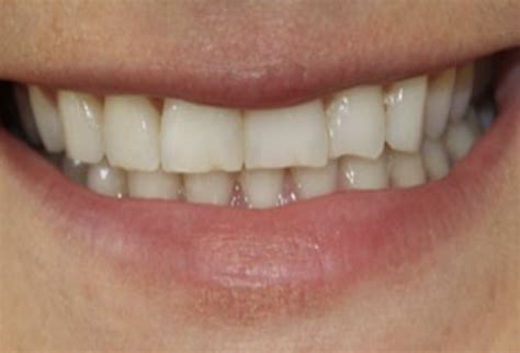 Porcelain Crowns Before & After Photos | Wellness Dental