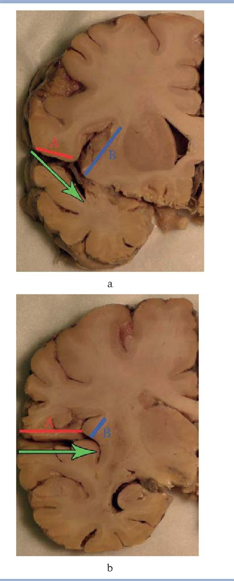 Figure 3 from [Surgical anatomy of the insular cortex]. | Semantic Scholar