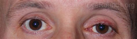 Conjunctival Lymphoma