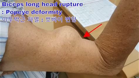 Popeye deformity, Biceps long head rupture - YouTube