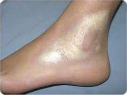 Morphea