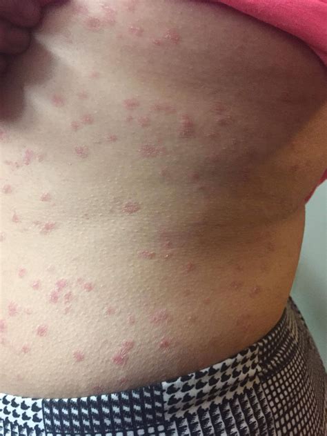 A painless, non contagious, yet rapid and recurring rash. Any ideas ...