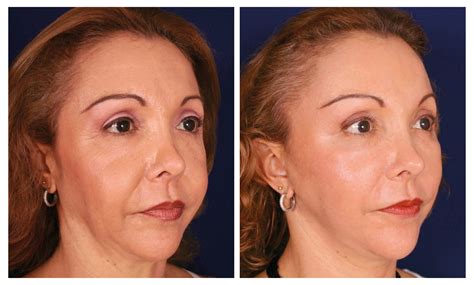 Rejuvenecimiento o Lifting Endoscópico ¡Refresca tu Rostro!