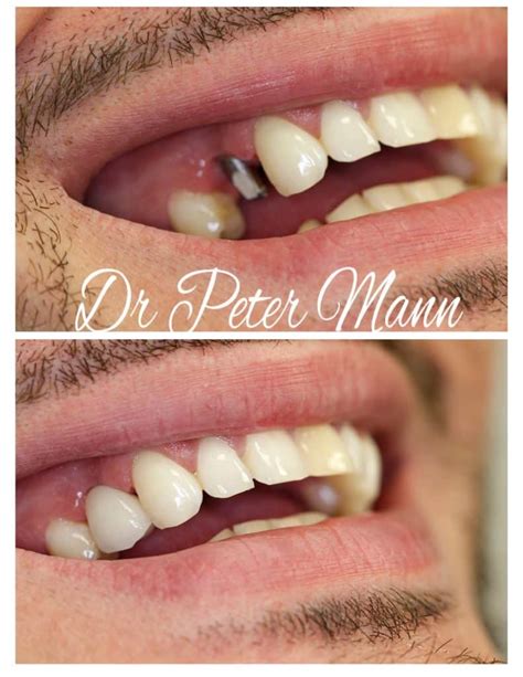 Dental Implants Before And After Photos | NYC Dentist