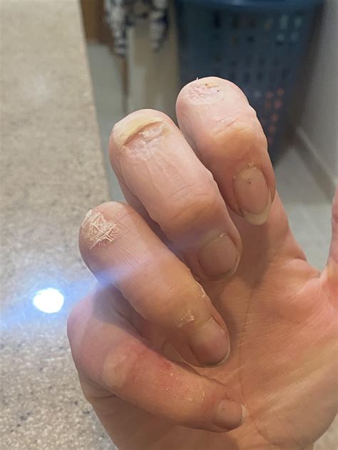 Hands feet face & warts , face &wart! Haaaaands feeeet face & warts