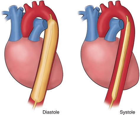 Proper Balloon Pump Placement