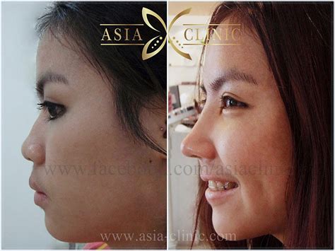 review rhinoplasty