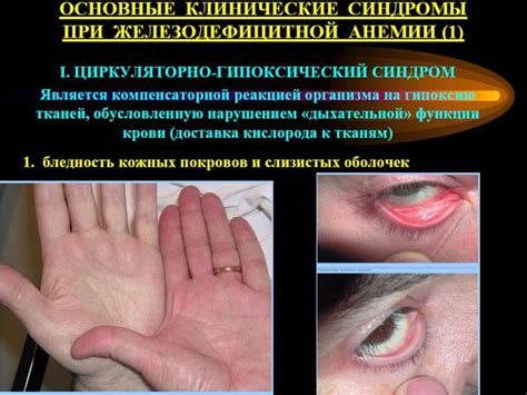 Анемии. Классификация анемий - презентация онлайн