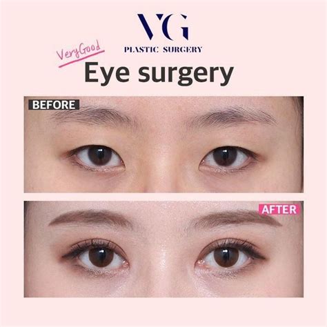 DOUBLE EYE LID SURGERY-VERYGOOD PLASTIC SURGERY