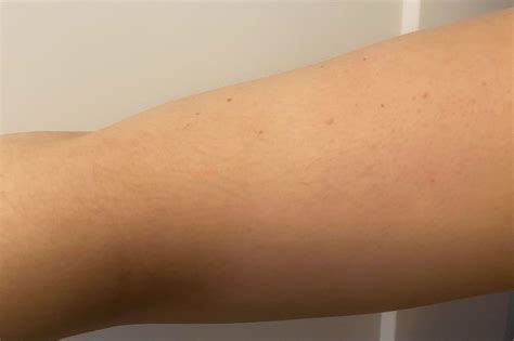 The Best Keratosis Pilaris Treatments, Tested by Health