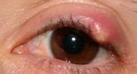Chalazion: Vs. Stye, Causes, Symptoms, Treatment, and More