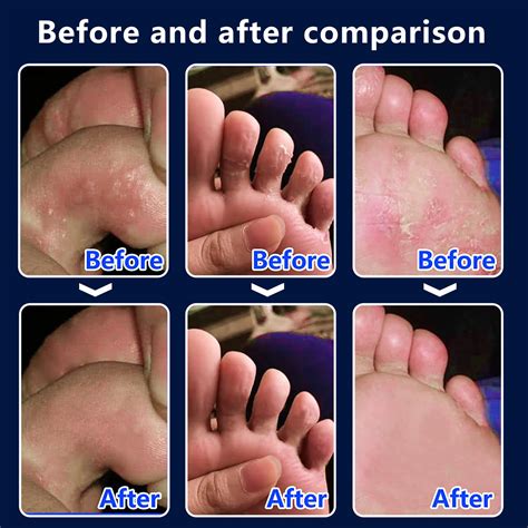 Vesicular Athletes Feet