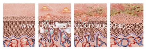 Stages of Eczema – Medical Stock Images Company