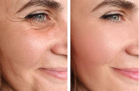 facelift surgery  islamabad pakistan rhytidectomy expert