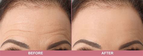 Top Treatment Options For Forehead Wrinkles in Vaughan - Forehead wrinkles