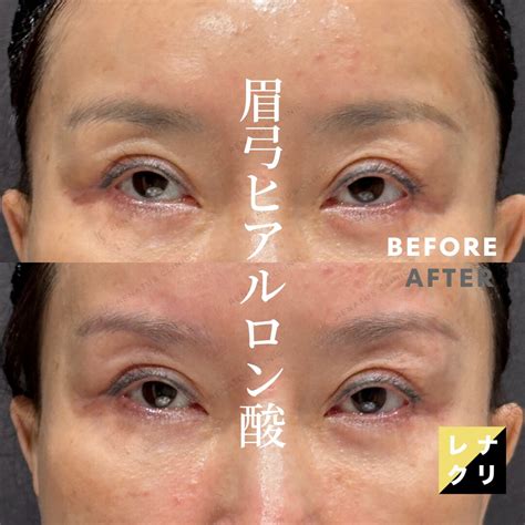 眉弓ヒアルロン酸ならレナトゥスクリニック（眉弓填充）