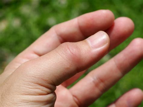 Ring Finger Joint Pain (around The Knuckle) - Damian Moore Kapsels