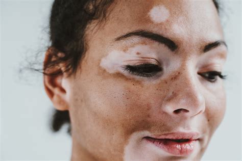 vitiligo ascot dermatology dr laura wheller brisbane dermatologist