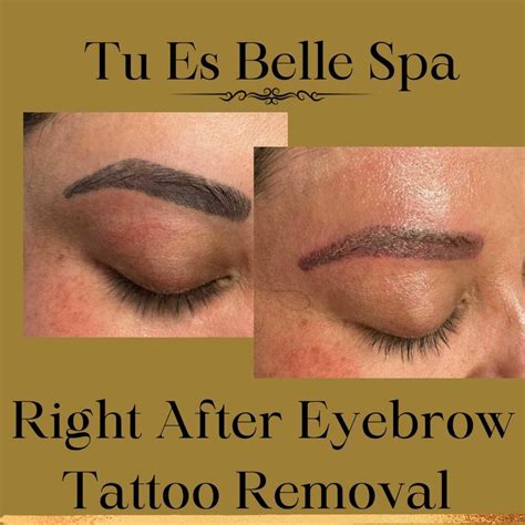 eyebrows tattoo removal 6