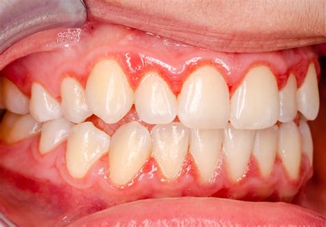 Gingivitis: Causes, Risks, and Treatments