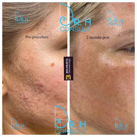 Acne Scar Laser Treatment & Removal London | Dr H Consult