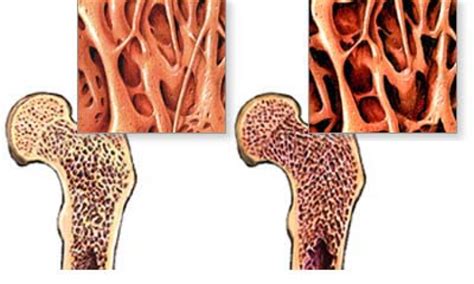 bone disease shalom adventure magazine