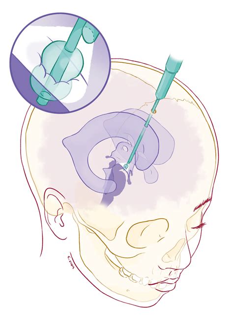 Cassandra Vion - Treating Sylvius aqueduct stenosis