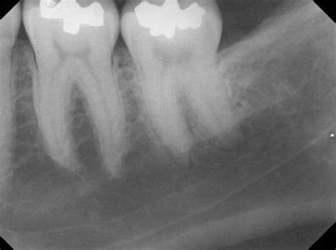 Submandibular Fossa Radiograph