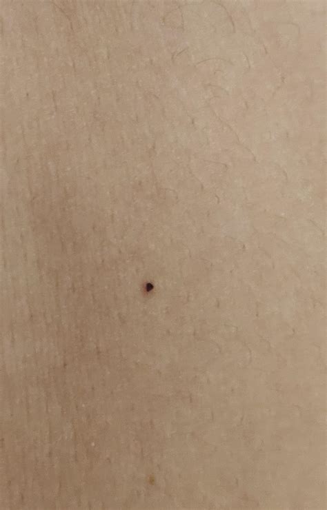 Black Dots On Arms And Back