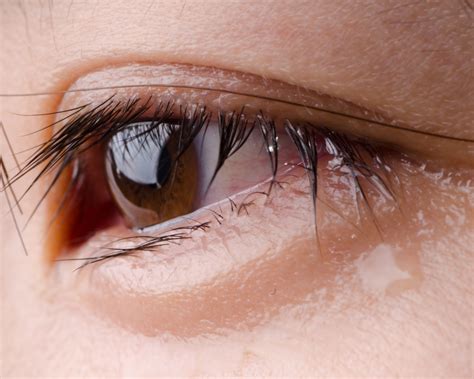 O Que Significa Olhos Marejados - Olhos marejados de secura • PANACEA
