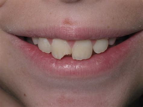 Chipped Molar