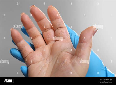 Contact dermatitis hands hi-res stock photography and images - Alamy