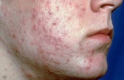 What can clear severe acne? | South Nassau Dermatology